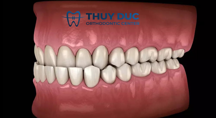 Răng bị móm phải làm sao? 1