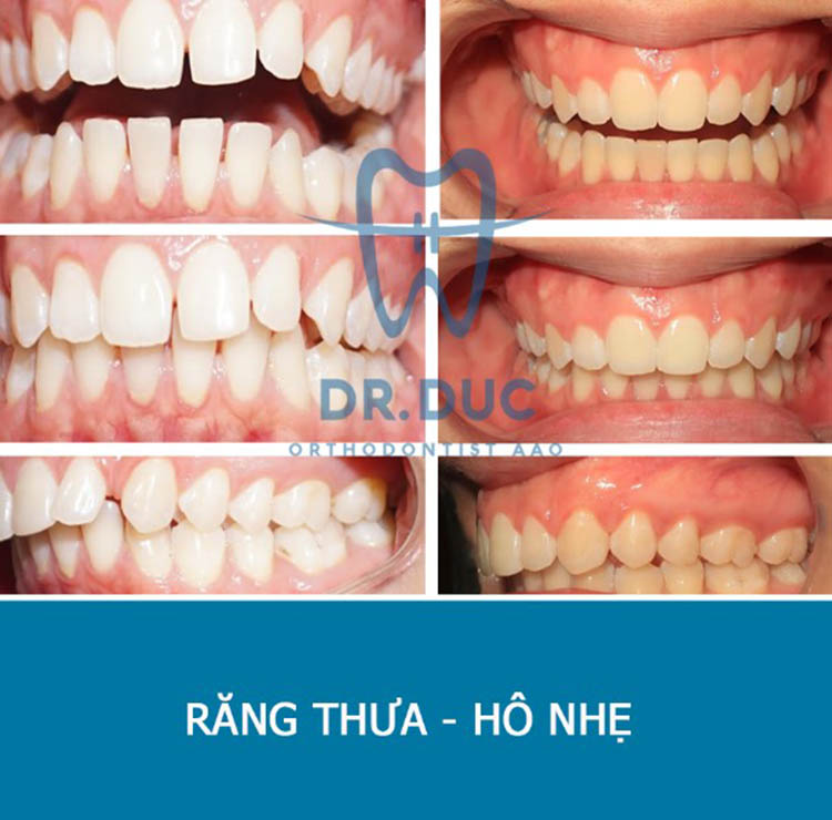 Trọn bộ hình ảnh thay đổi bất ngờ trước - sau niềng răng - Bác sĩ ...