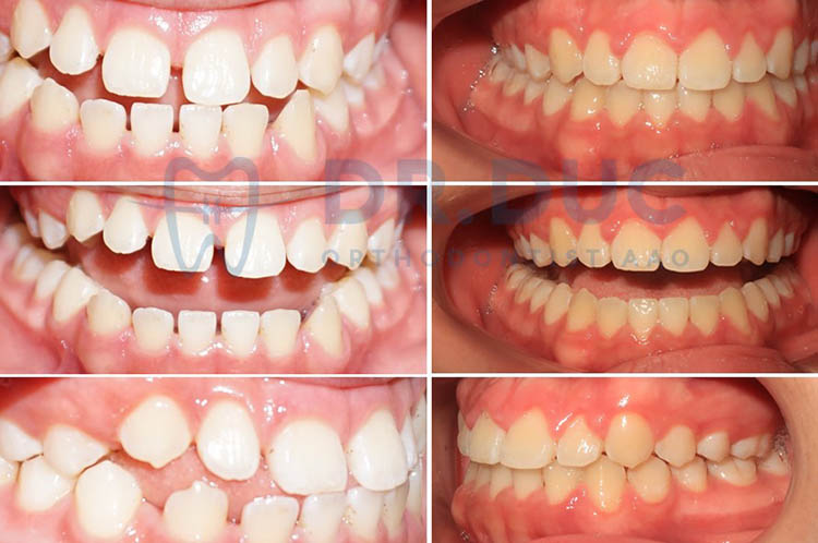 Hình ảnh trước – sau niềng răng với răng thưa 3 Hình ảnh trước – sau niềng răng với răng thưa 3