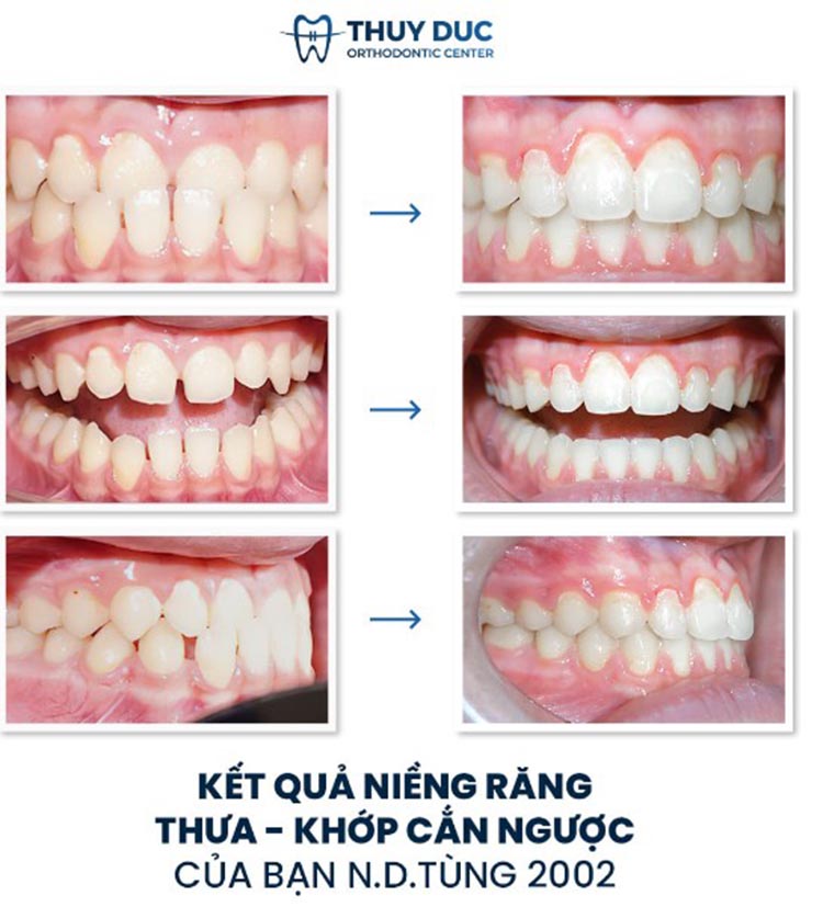 Hình ảnh trước – sau niềng răng với răng phức tạp khác 4 Hình ảnh trước – sau niềng răng với răng phức tạp khác 4