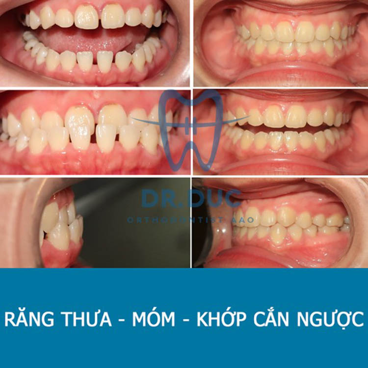 Hình ảnh trước – sau niềng răng với răng phức tạp khác 5 Hình ảnh trước – sau niềng răng với răng phức tạp khác 5