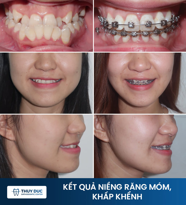 Bước 6: Tháo mắc cài, duy trì kết quả 1 Bước 6: Tháo mắc cài, duy trì kết quả 1