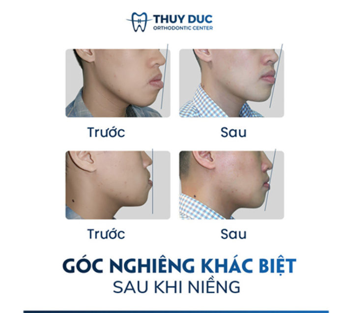Gây mất thẩm mỹ khuôn mặt 1