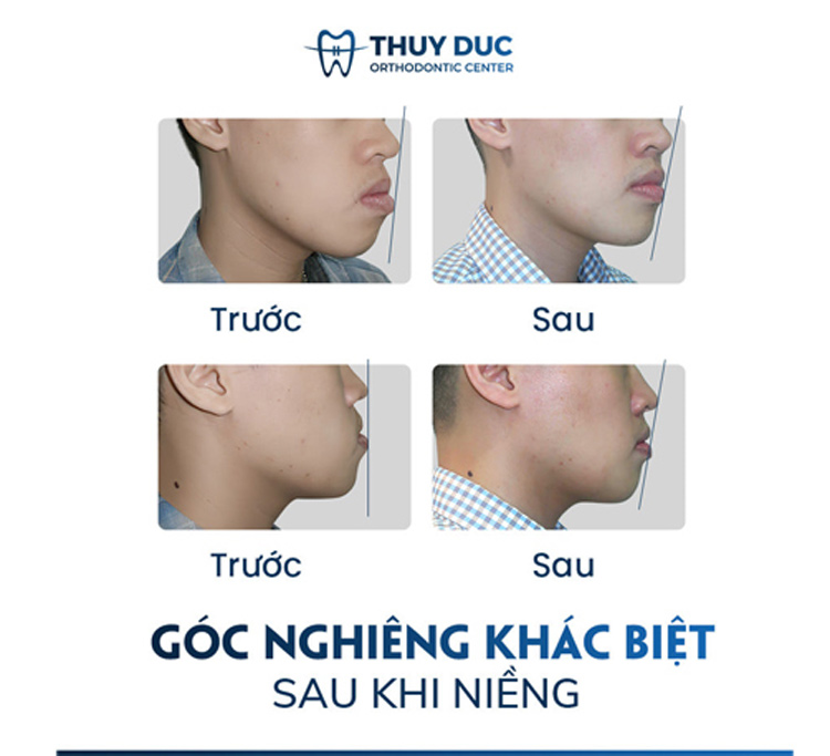 Phẫu thuật hàm móm giúp chàng trai 9x có vẻ ngoài điển trai  Ngôi sao