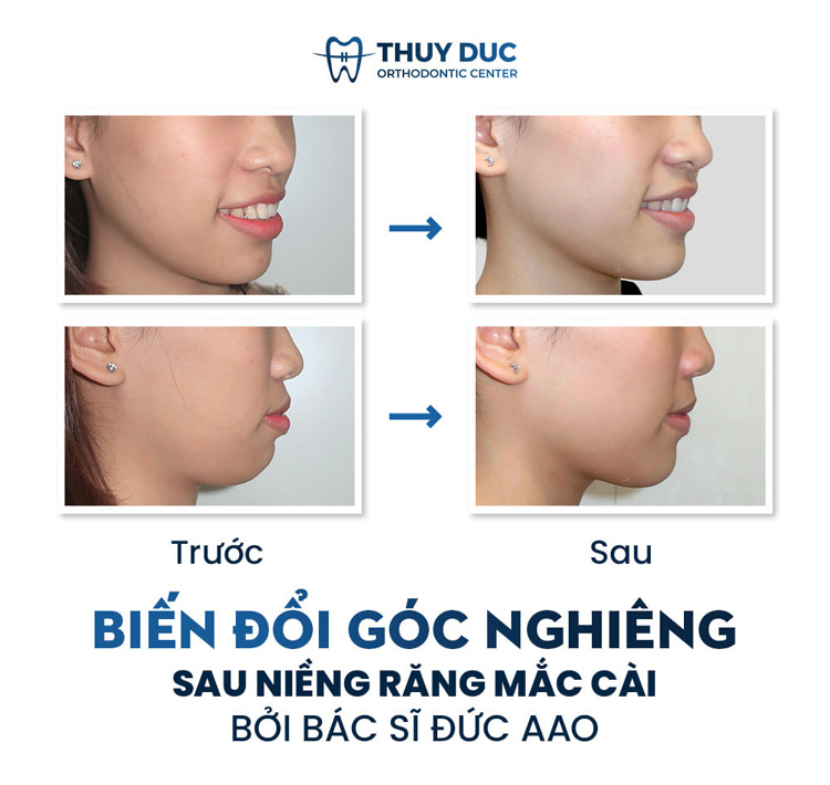 Niềng răng mắc cài Damon tại Nha Khoa Thuý Đức 1