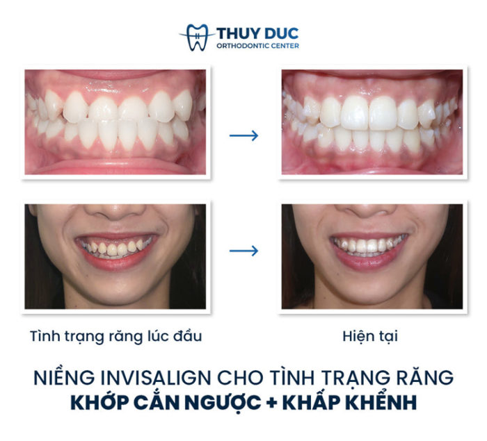 Khớp cắn ngược và cách điều trị 1