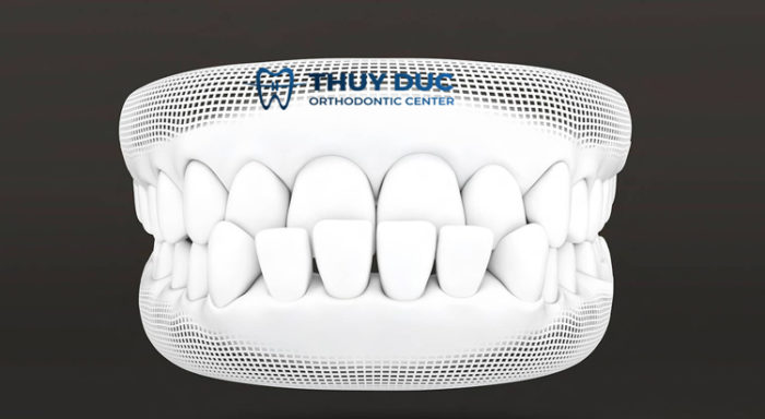 Nguyên nhân và cách khắc phục tình trạng niềng răng xong bị móm 1