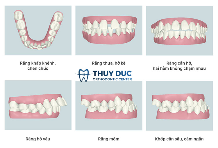 Trường hợp nào nên niềng răng mắc cài kim loại tự đóng? 1 Trường hợp nào nên niềng răng mắc cài kim loại tự đóng? 1