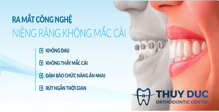 Ưu điểm của niềng răng Ecligner 1 Ưu điểm của niềng răng Ecligner 1