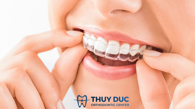 Ưu điểm vượt trội của niềng răng Invisalign 1 Ưu điểm vượt trội của niềng răng Invisalign 1