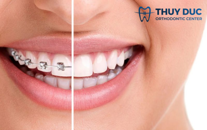 Có nên tẩy trắng răng khi đang niềng răng hay không? 1 Có nên tẩy trắng răng khi đang niềng răng hay không? 1