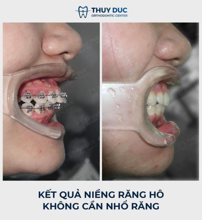 Kết quả niềng răng hô tại Nha khoa Thúy Đức 4 Kết quả niềng răng hô tại Nha khoa Thúy Đức 4