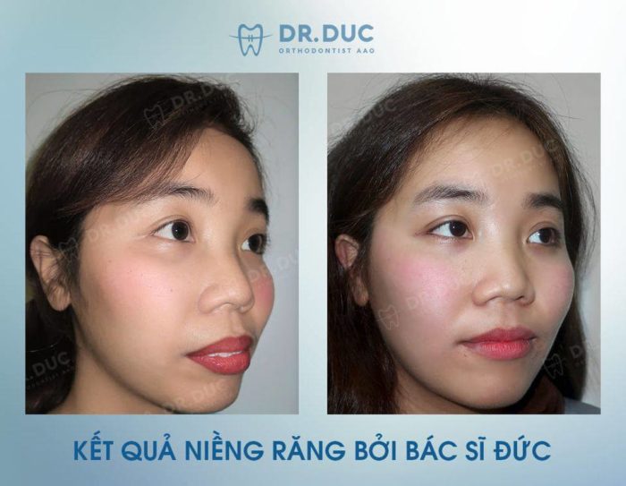 Kết quả niềng răng hô tại Nha khoa Thúy Đức 1 Kết quả niềng răng hô tại Nha khoa Thúy Đức 1