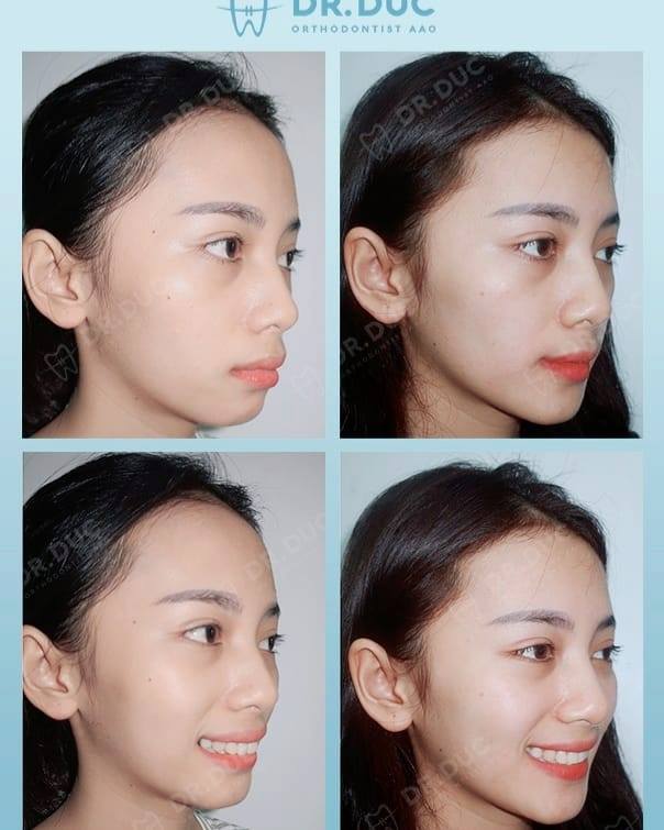 Kết quả niềng răng hô tại Nha khoa Thúy Đức 3 Kết quả niềng răng hô tại Nha khoa Thúy Đức 3