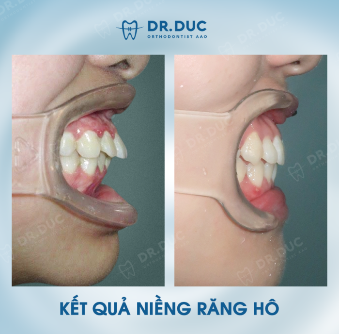 Kết quả niềng răng hô tại Nha khoa Thúy Đức 6 Kết quả niềng răng hô tại Nha khoa Thúy Đức 6