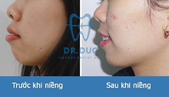 Kết quả niềng răng hô tại Nha khoa Thúy Đức 5 Kết quả niềng răng hô tại Nha khoa Thúy Đức 5