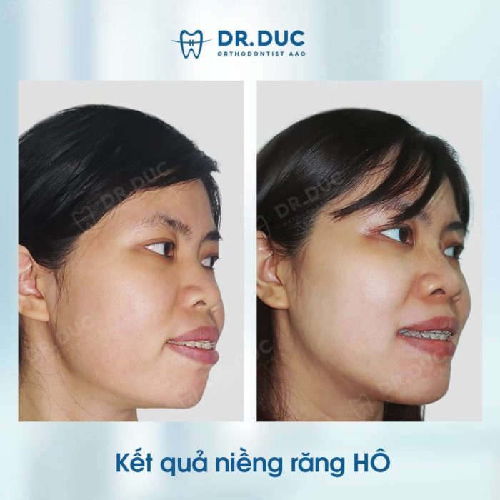 Kết quả niềng răng hô tại Nha khoa Thúy Đức 8 Kết quả niềng răng hô tại Nha khoa Thúy Đức 8
