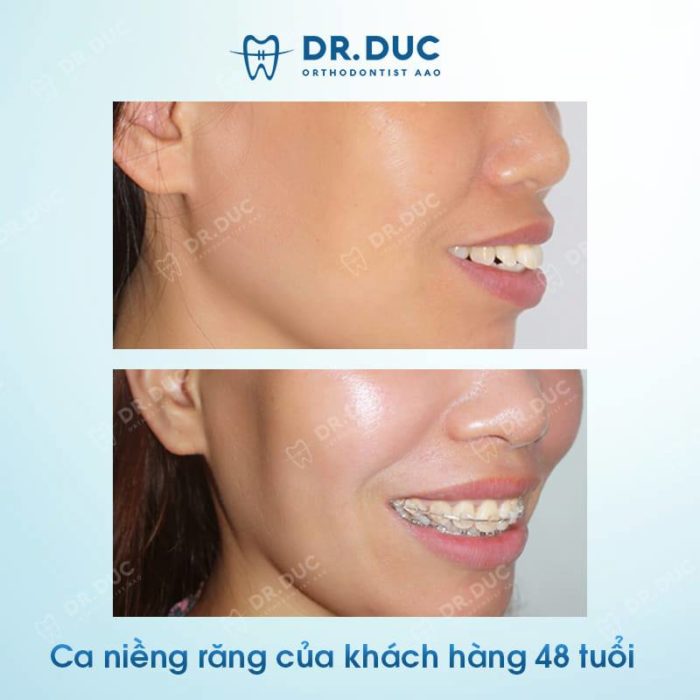 Kết quả niềng răng hô tại Nha khoa Thúy Đức 2 Kết quả niềng răng hô tại Nha khoa Thúy Đức 2