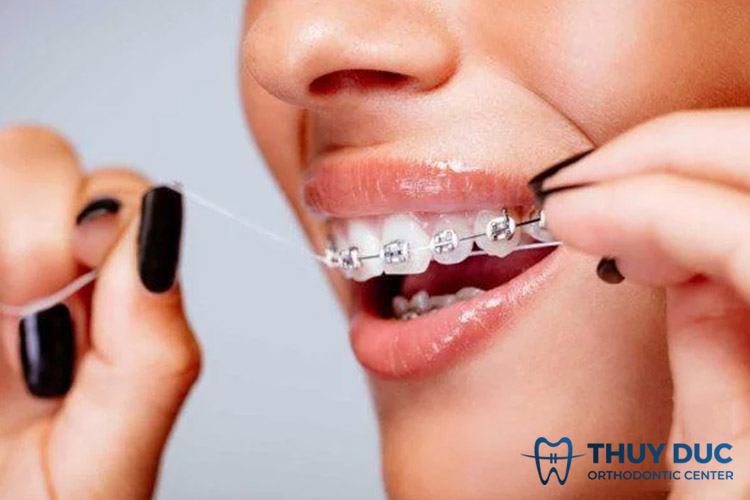 Chỉ nha khoa 1 Chỉ nha khoa 1