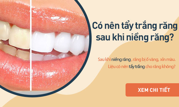 Có nên tẩy trắng răng sau khi niềng răng không? 1 Có nên tẩy trắng răng sau khi niềng răng không? 1