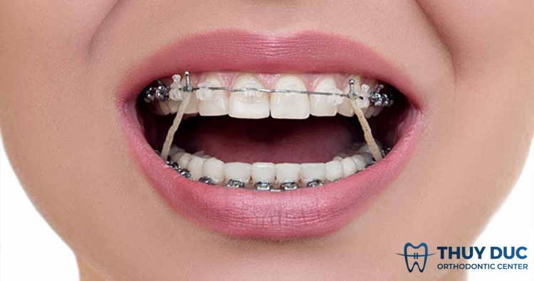  Dây thun niềng răng bị vàng để có hàm răng sáng bóng và trắng hơn