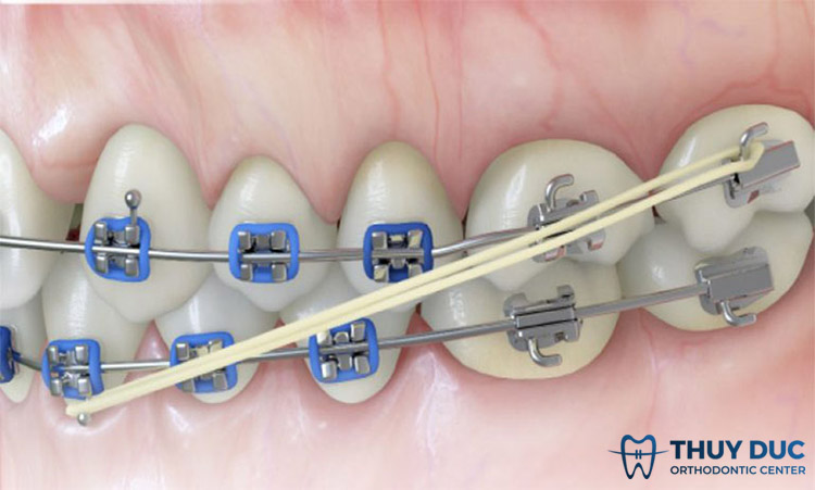 Dây thun niềng răng bị ố vàng ảnh hưởng gì không? 1