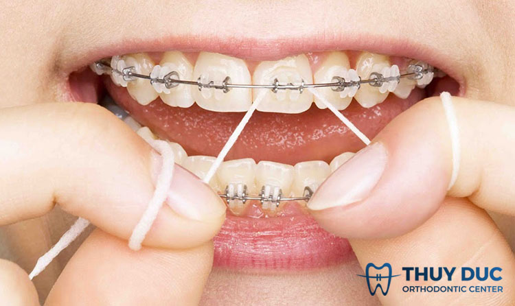 Dùng chỉ nha khoa 1