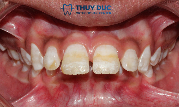 Răng hô hàm trên là gì? 1 Răng hô hàm trên là gì? 1