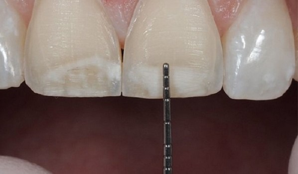 Phương pháp mài răng hô 1 Phương pháp mài răng hô 1