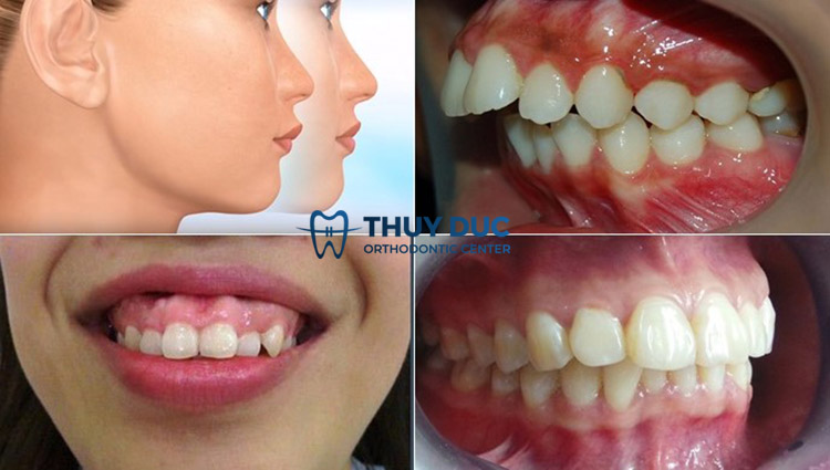 Cách nhận biết răng hô hàm trên 1 Cách nhận biết răng hô hàm trên 1