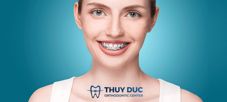 Niềng răng hô hàm trên hết bao nhiêu chi phí? 1 Niềng răng hô hàm trên hết bao nhiêu chi phí? 1