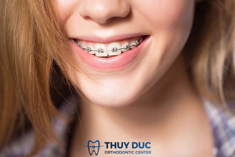 Niềng răng mắc cài kim loại truyền thống 1 Niềng răng mắc cài kim loại truyền thống 1