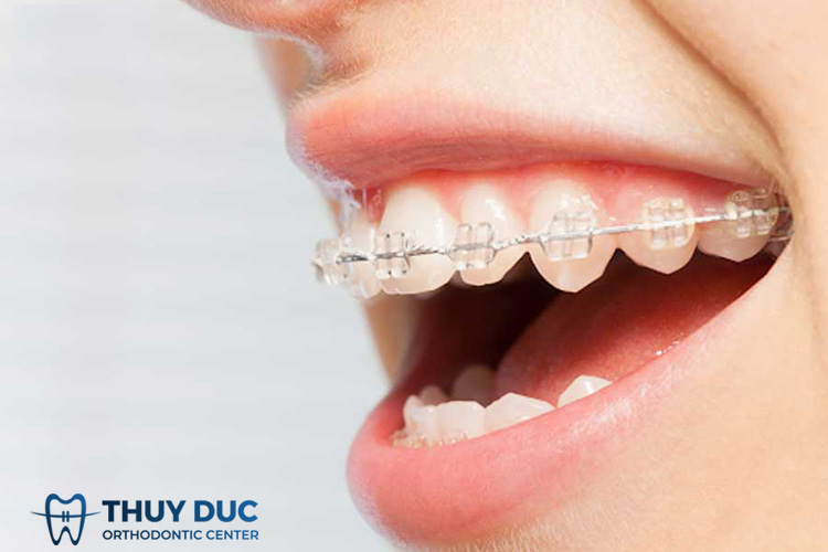Niềng răng mắc cài sứ truyền thống 1 Niềng răng mắc cài sứ truyền thống 1