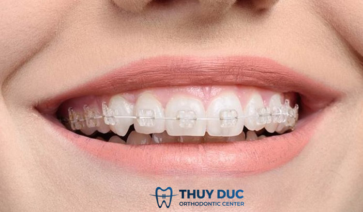 Niềng răng mắc cài sứ tự đóng 1 Niềng răng mắc cài sứ tự đóng 1