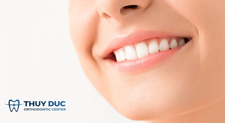 Niềng răng móm trong bao lâu? 1 Niềng răng móm trong bao lâu? 1