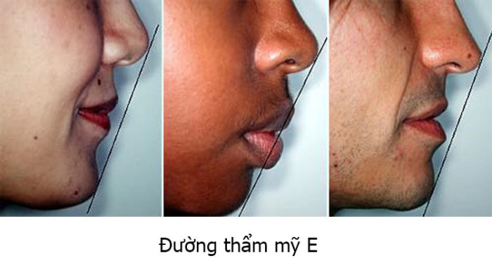 Nhận biết răng hô nhẹ như thế nào? 1 Nhận biết răng hô nhẹ như thế nào? 1