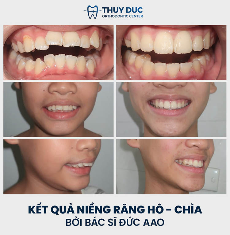Các phương pháp niềng răng hô đa dạng 2 Các phương pháp niềng răng hô đa dạng 2