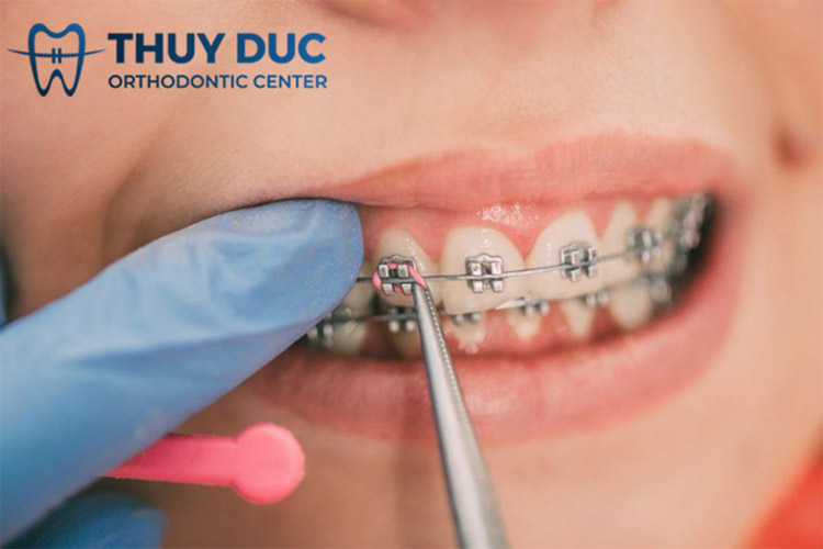 Cách xử lý dây thun niềng răng bị ố vàng 1