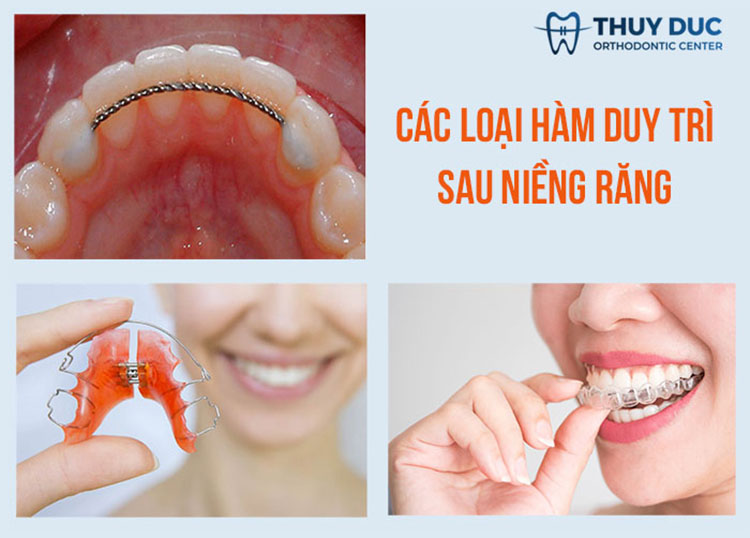 Vì sao bạn cần phải đeo hàm duy trì? 1 Vì sao bạn cần phải đeo hàm duy trì? 1