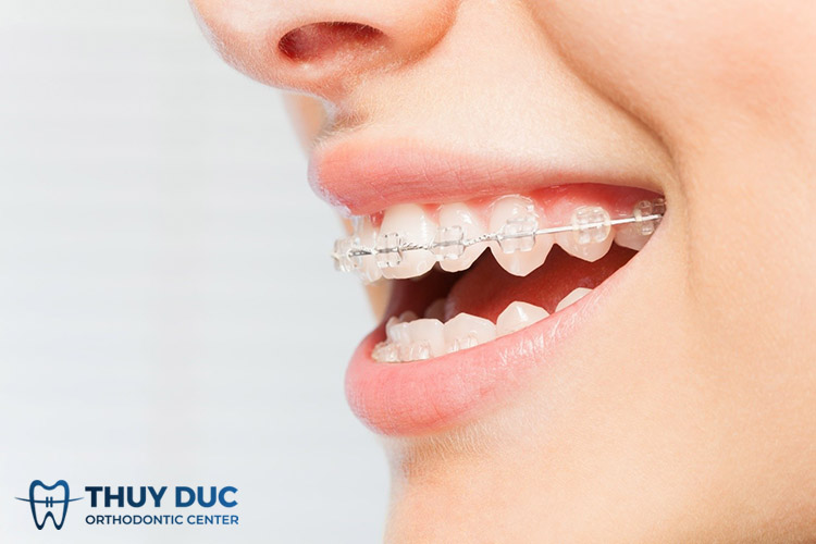 Một số câu hỏi liên quan đến niềng răng mắc cài sứ truyền thống 1 Một số câu hỏi liên quan đến niềng răng mắc cài sứ truyền thống 1