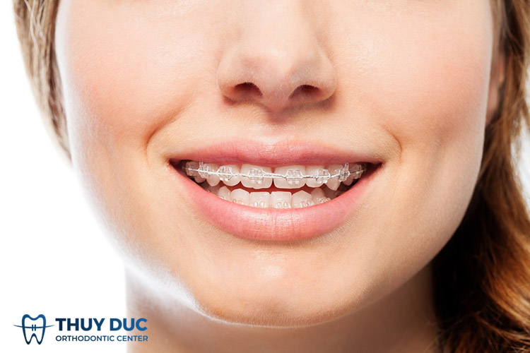 Niềng răng mắc cài sứ Damon Clear là gì? 1 Niềng răng mắc cài sứ Damon Clear là gì? 1