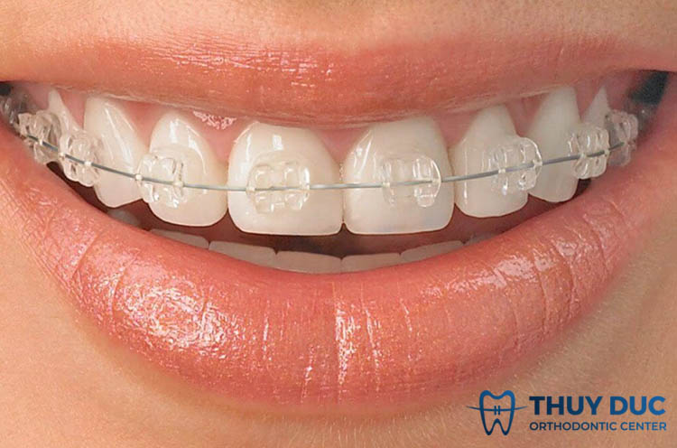 Niềng răng mắc cài sứ truyền thống là gì? 1 Niềng răng mắc cài sứ truyền thống là gì? 1