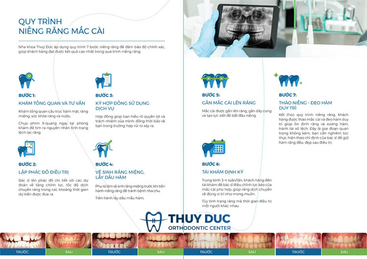 Quy trình niềng răng mắc cài sứ truyền thống 1 Quy trình niềng răng mắc cài sứ truyền thống 1