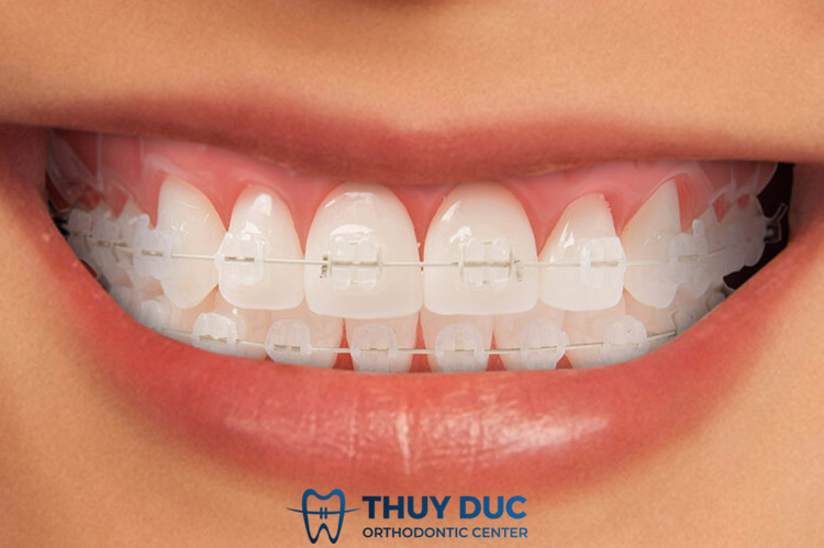 Những ưu điểm vượt trội niềng răng mắc cài sứ Damon Clear 1 Những ưu điểm vượt trội niềng răng mắc cài sứ Damon Clear 1