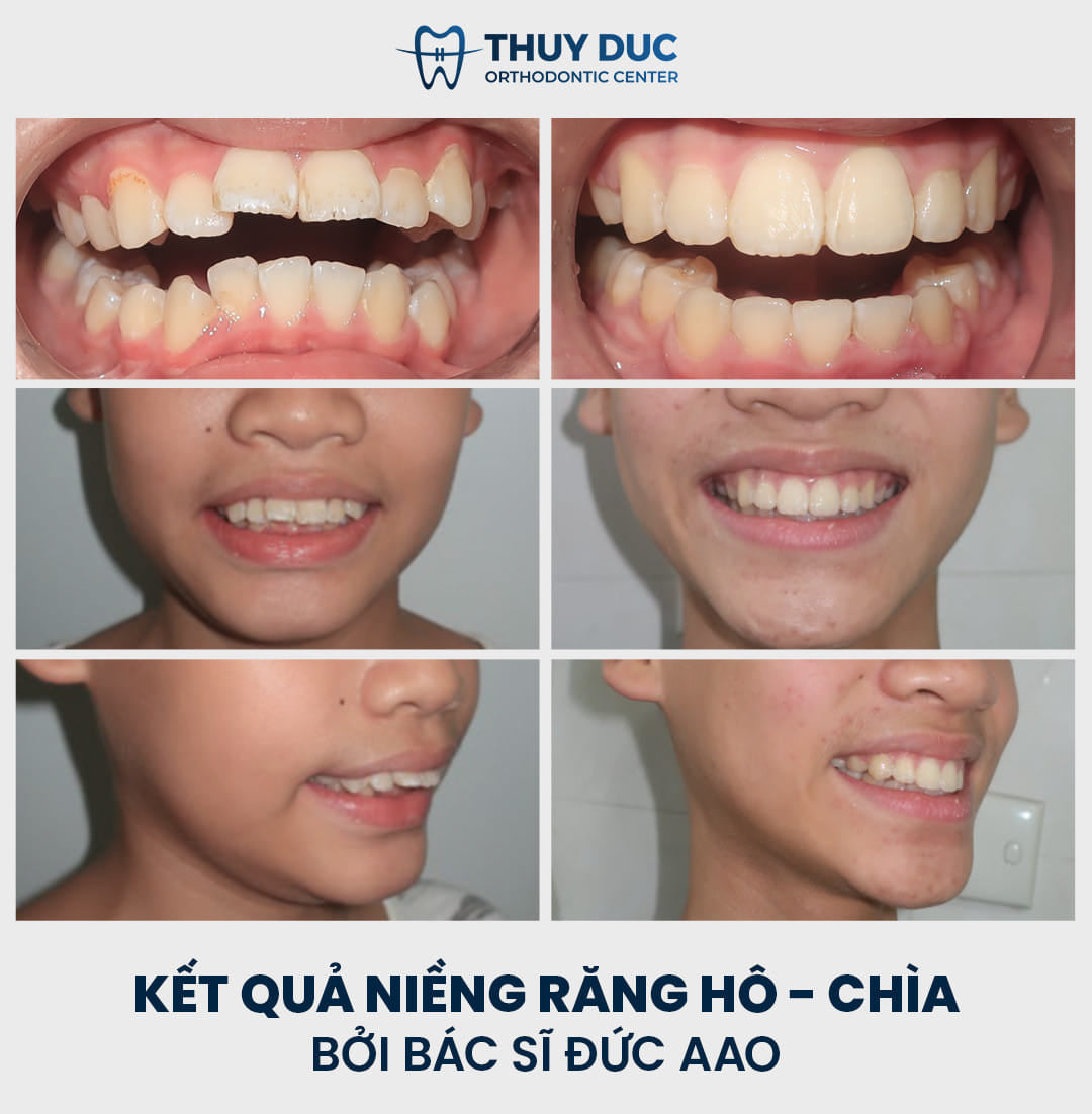 Hình ảnh thay đổi trước và sau khi niềng răng hô tại Nha khoa Thúy Đức 5