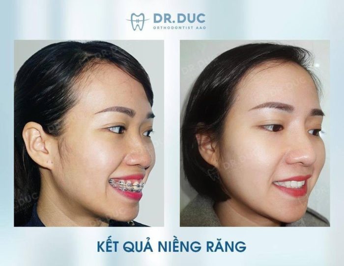 Hình ảnh Thay đổi Trước Và Sau Khi Niềng Răng Hô Bác Sĩ Đức Aao 8546