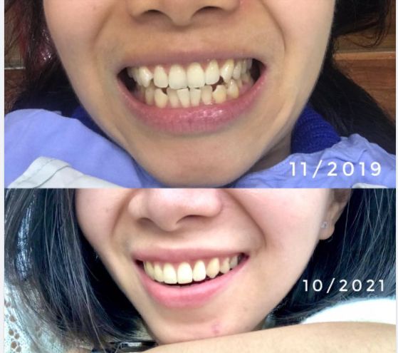 Feedback của khách hàng niềng răng tại Nha khoa Thúy Đức 4