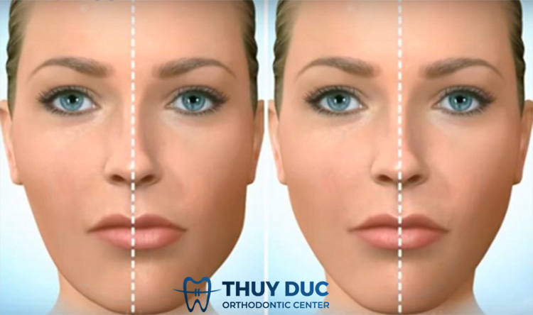 Tìm hiểu bị lệch nhân trung là gì? 1