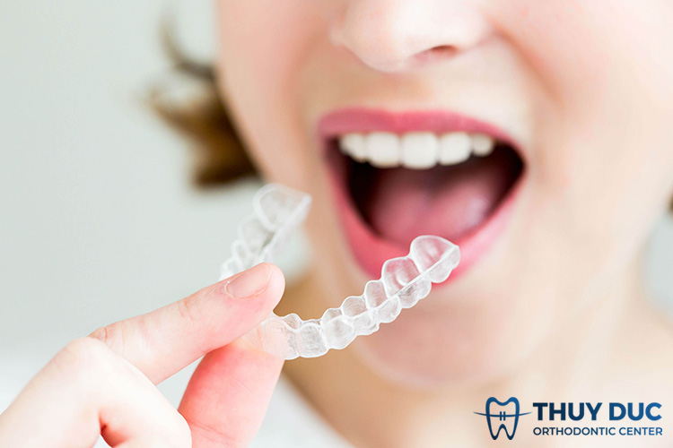 Chỉnh răng móm bằng khay niềng trong suốt giá bao nhiêu? 1
