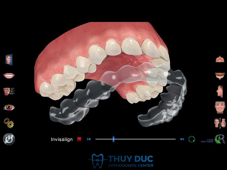 Chỉnh răng móm bằng khay niềng trong suốt hiệu quả ra sao? 1